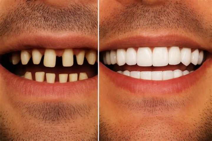 Unveiling The Secrets Of Gorilla Teeth: Before And After